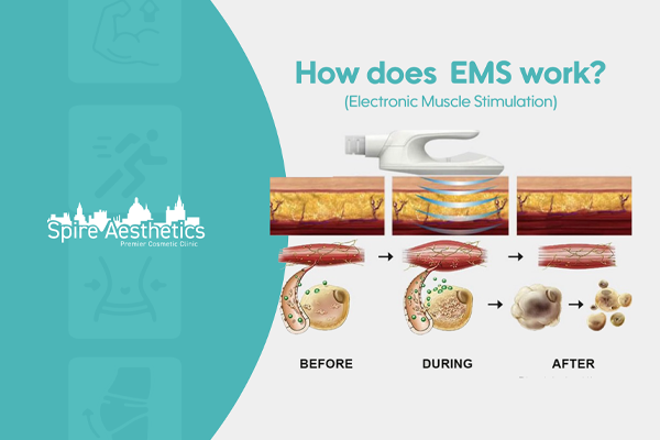 EMS treatment for post pregnancy weight loss treatment Rowley Regis