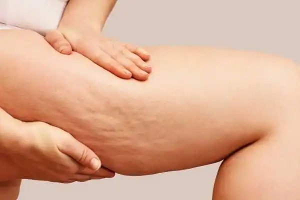 Image of woman showing leg with cellulite Rowley Regis