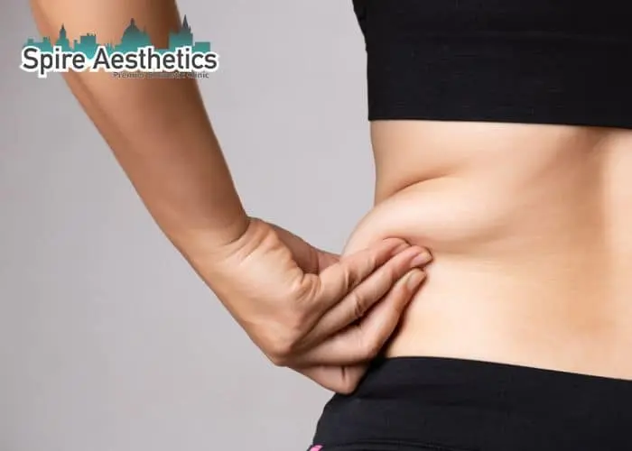 Image of woman pinching fat on their hips Rowley Regis. Fat Freezing treatment