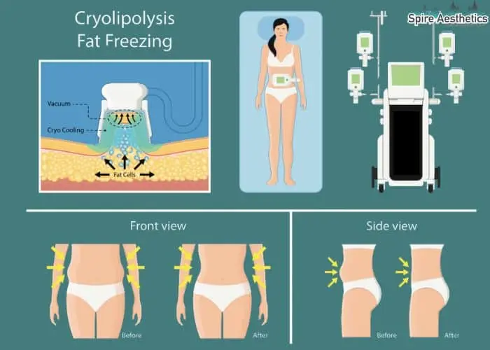Fat freezing treatment Rowley Regis benefits for competitions to remove stubborn fat deposits.