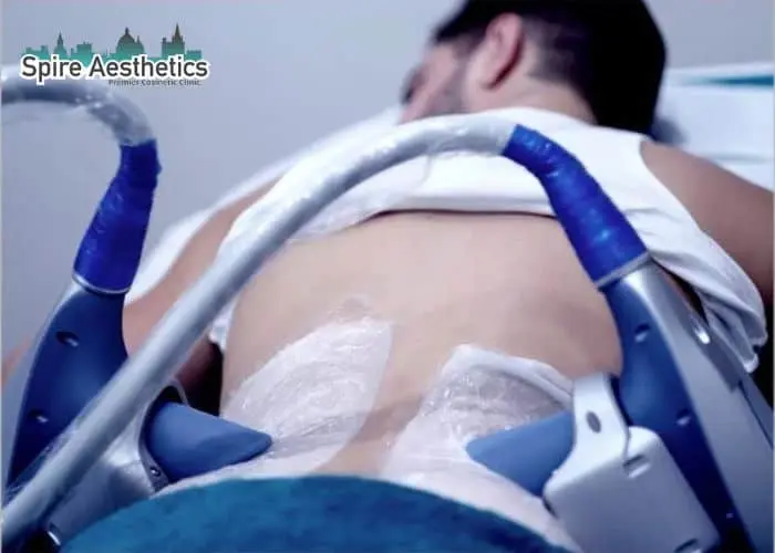 Man having fat freezing treatment done on love handles before a competitions Rowley Regis to create a sculpted look.