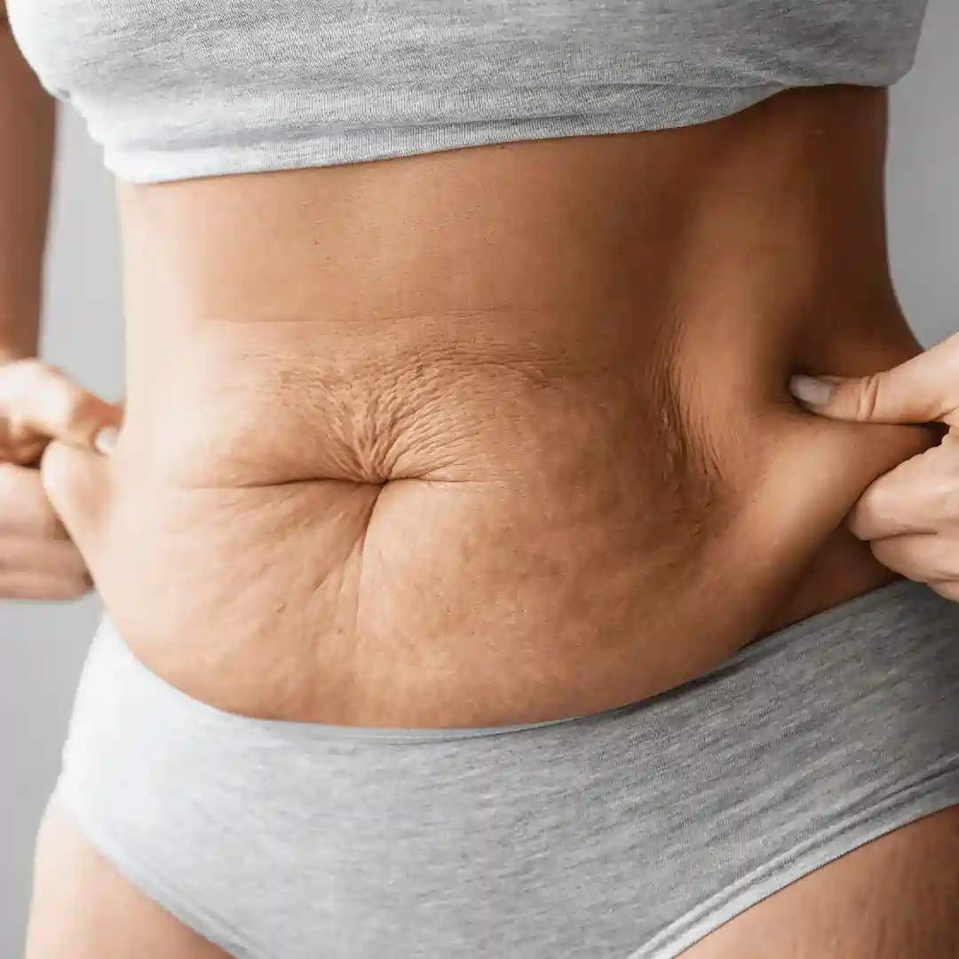 Is It Normal to Have Loose Skin After Pregnancy Rowley Regis?