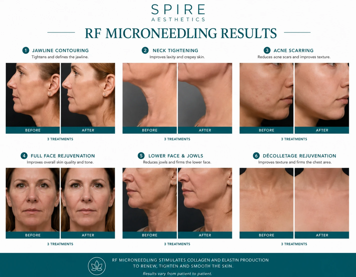 RF Microneedling Skin tightening Rowley Regis results