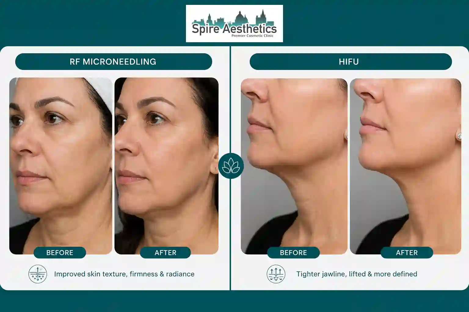 Can RF Microneedling and HIFU Be Combined Rowley Regis?