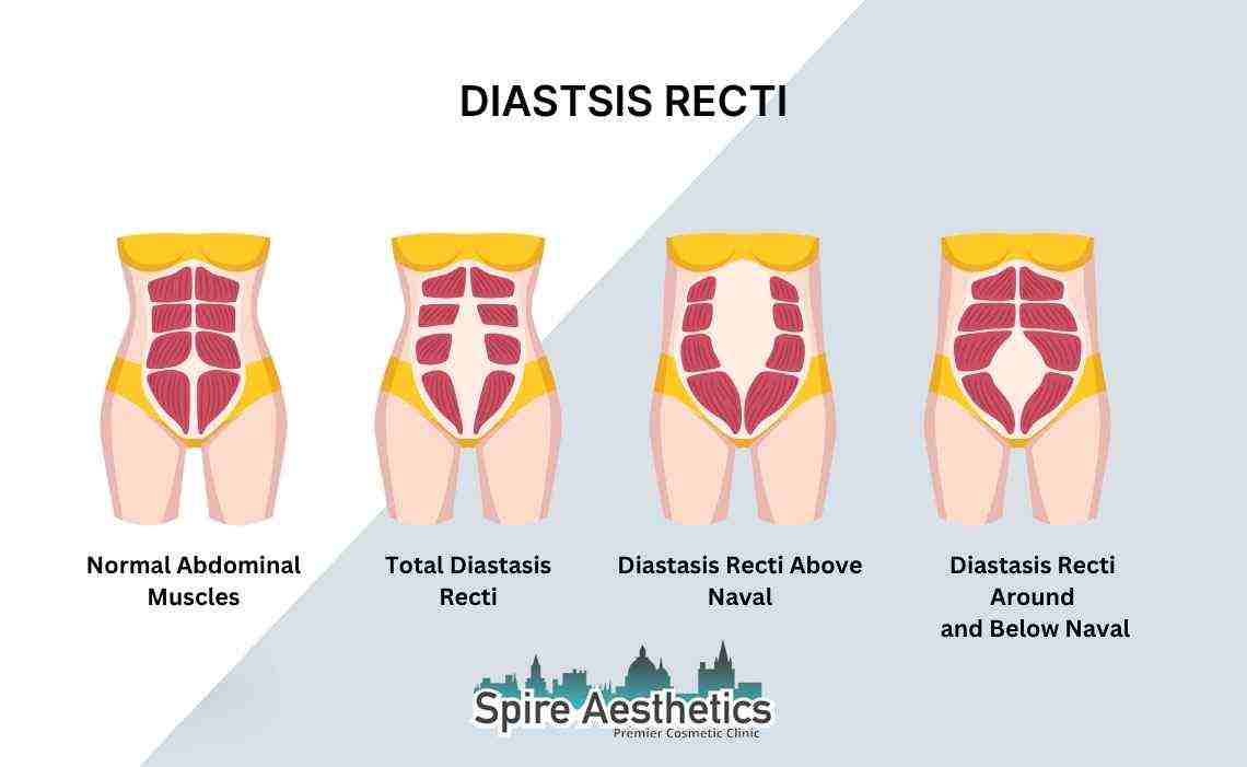 Is Non-Surgical Diastasis Recti Treatment Right for You? Common Concerns Answered Rowley Regis